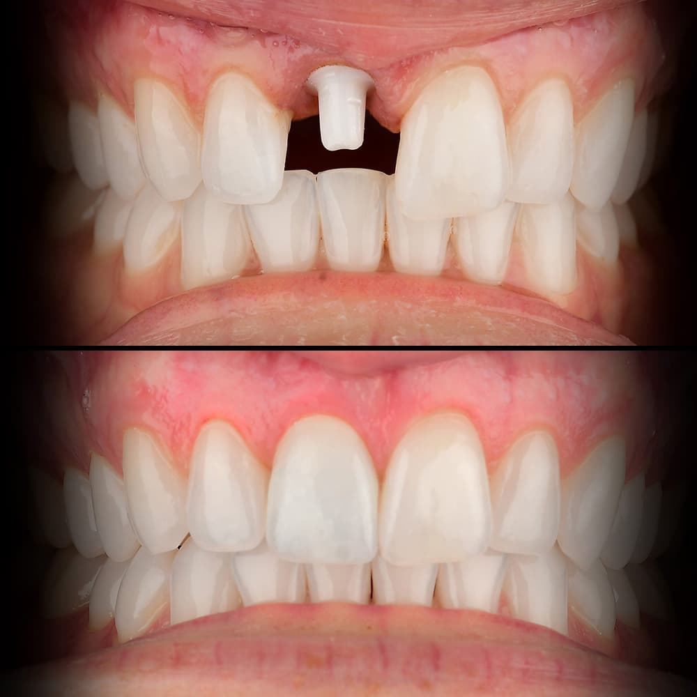 Before and after dental case 1
