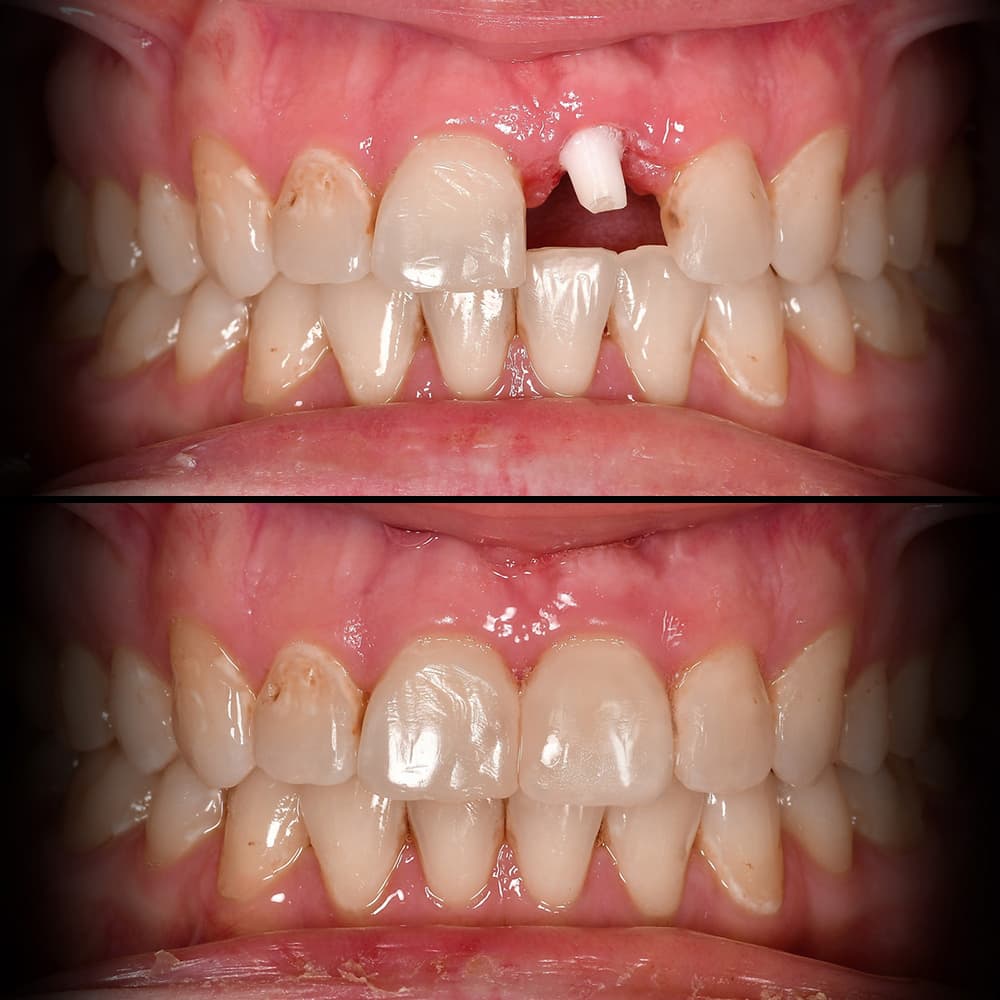 Before and after full arch ceramic implants