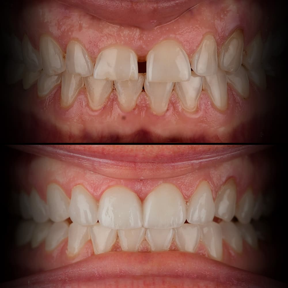 Before and after dental case 14