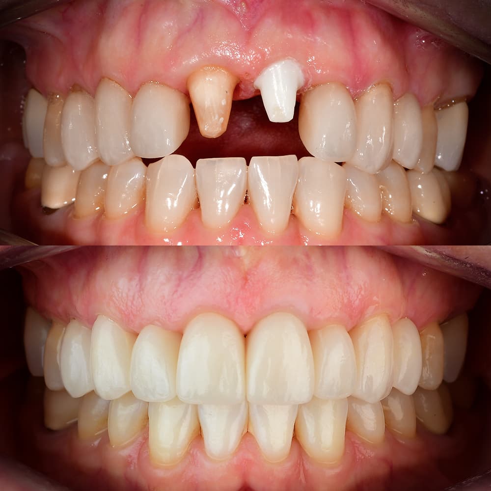 Before and after 1 front ceramic implant