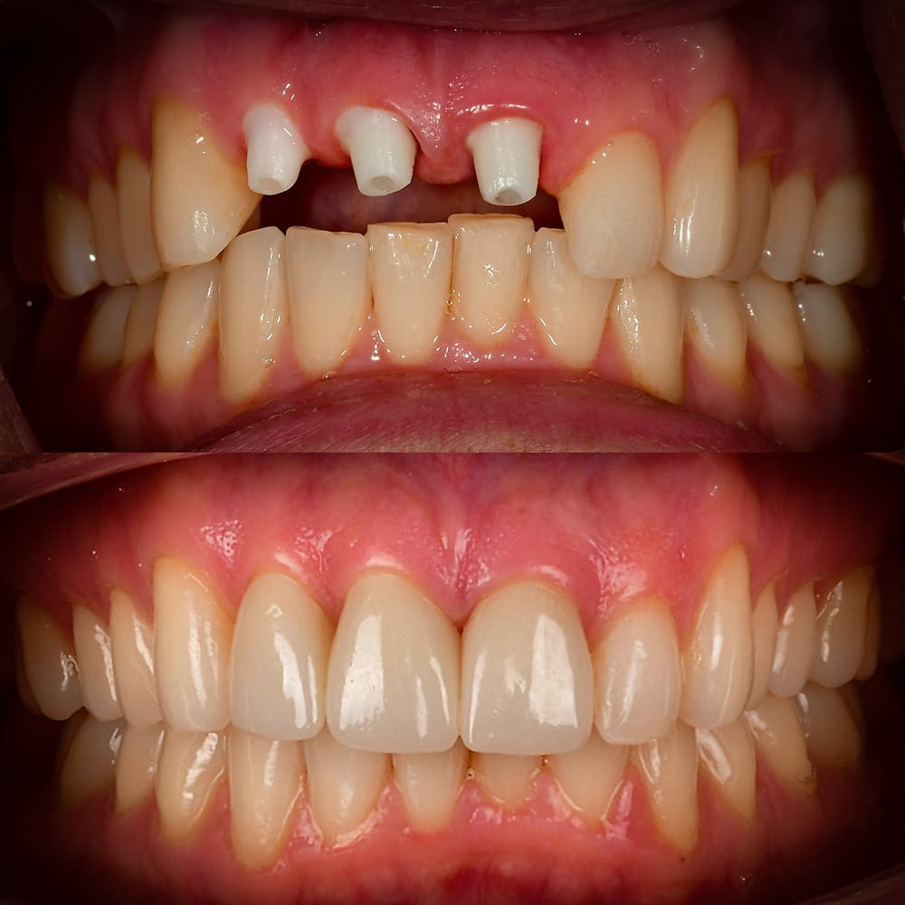 Before and after 3 front tooth ceramic implants