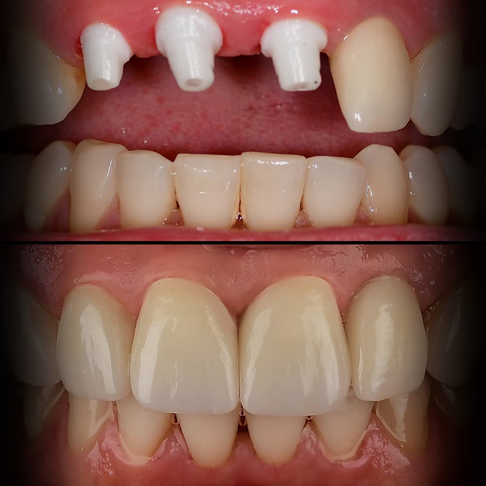 Before and after dental case 6