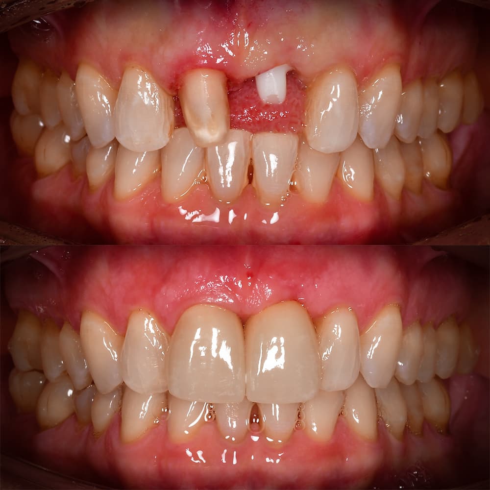 Before and after dental case 9