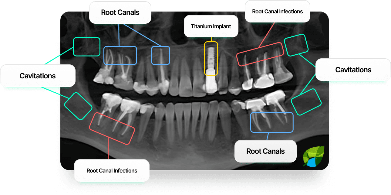 Marked 3D CBCT scan showing root canals, titanium implant, root canal infections, and cavitations