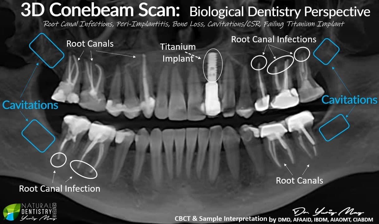 Annotated CBCT 3D cone beam scan revealing root canal infections, cavitations, and a failing titanium implant