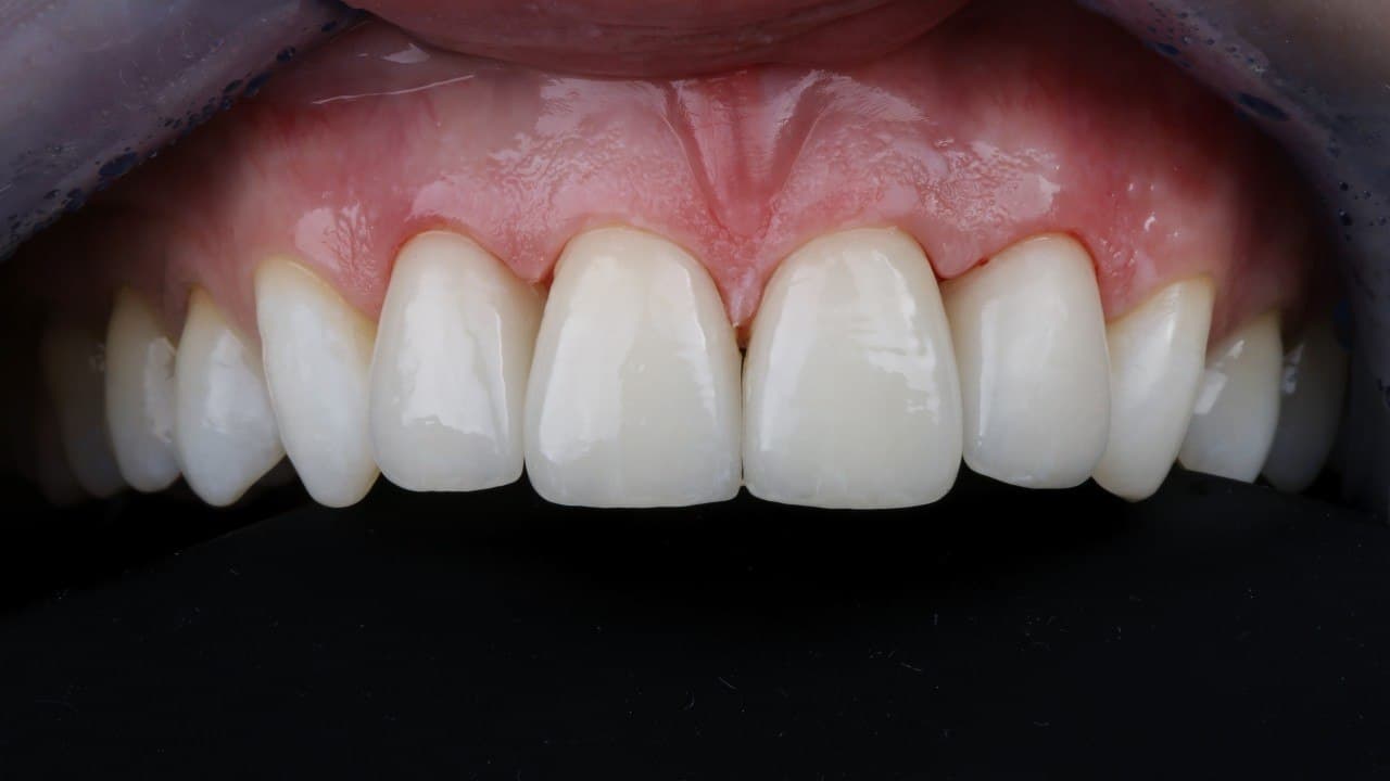 Completed metal-free ceramic restoration matched precisely to natural tooth anatomy
