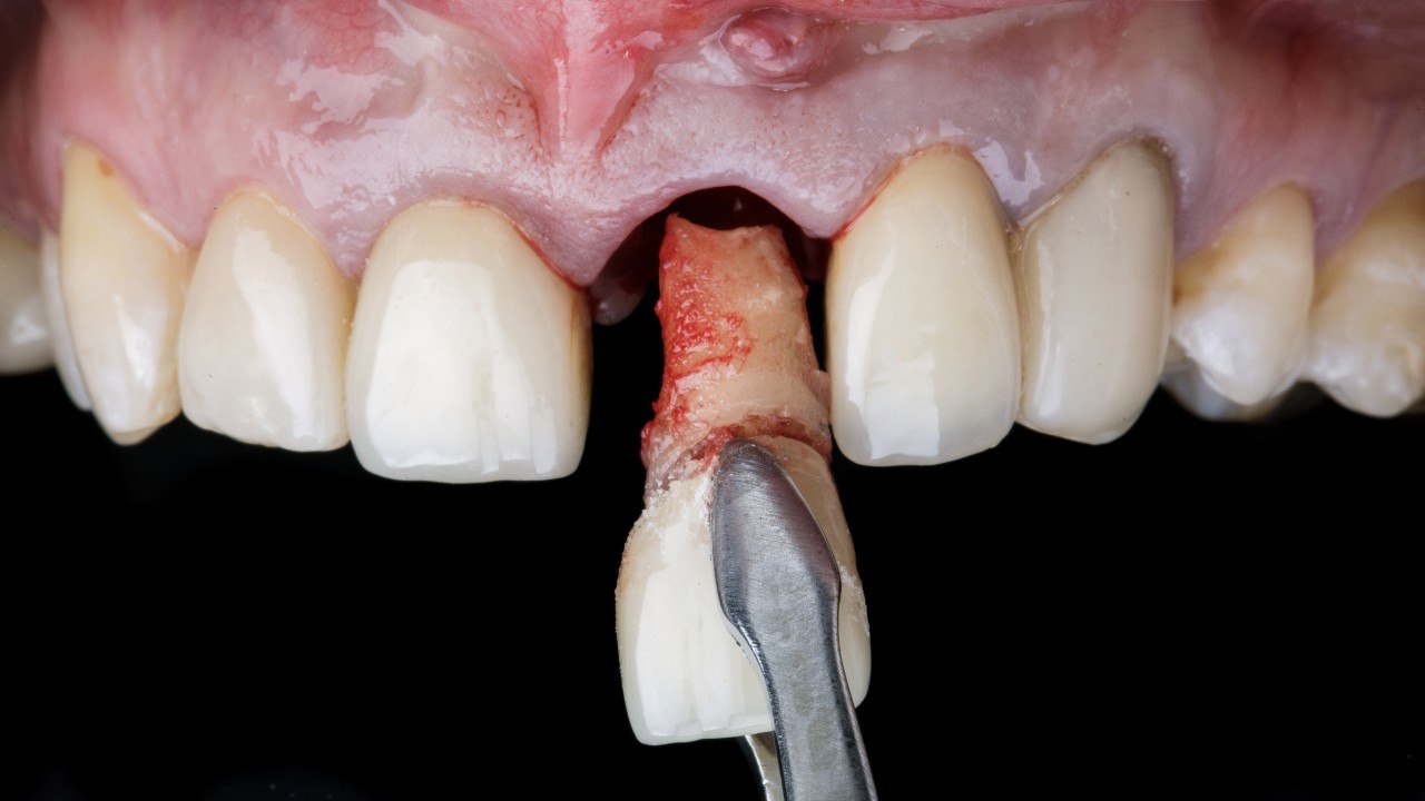 Biological extraction and site preparation