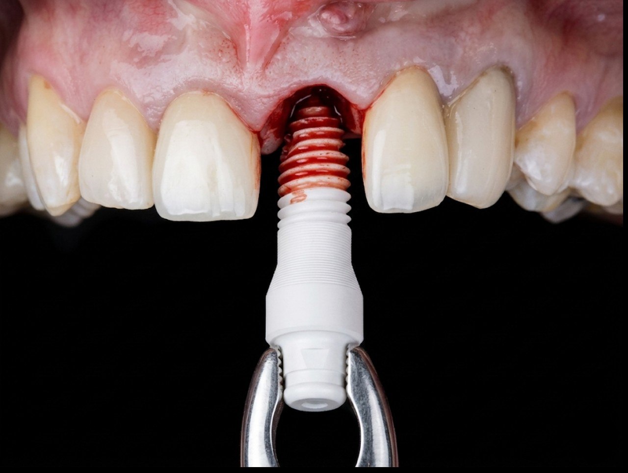 Zirconia ceramic implant placement
